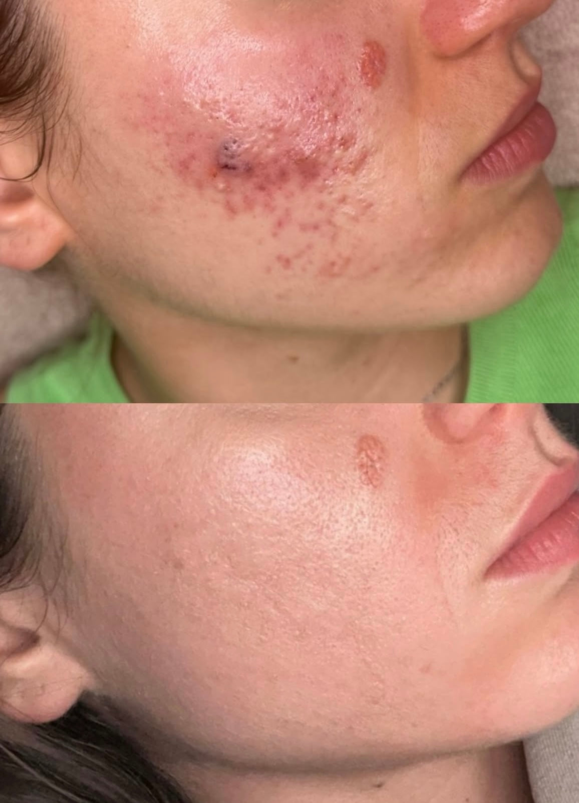 Très efficace ! Ma peau est plus douce et mes boutons ont diminué. Je recommande ce masque LED rouge sans hésiter !